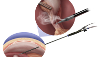 Laparoscopic smoke evacuation surgical device system