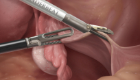 Fully-integrated bipolar and ultrasonic surgical instruments used in a total laparoscopic hysterectomy